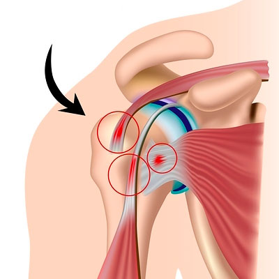 tendinopathies-coiffe-rotateurs.jpg